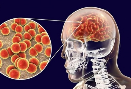 Những điều cần biết về bệnh do não mô cầu, người dân cần chủ động phòng tránh 