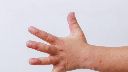 Bệnh tay chân miệng bùng phát và gia tăng nhanh