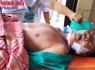 Hà Tĩnh: Cấp cứu kịp thời bệnh nhân người Lào bị ngừng hô hấp
